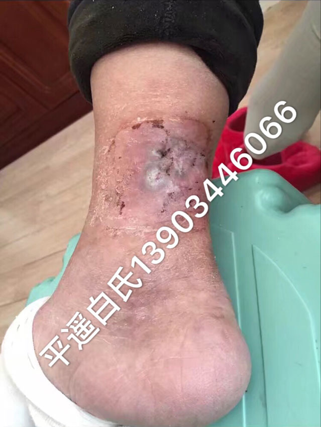 治疗中 治愈   张爱芝,女,64岁(肾移植病人).